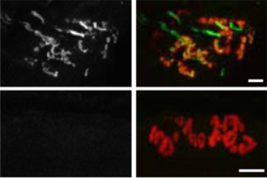 Investigating the role of miRNA in ALS disease progression