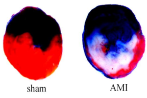 Serum miR-1 could be a novel sensitive diagnostic biomarker for acute myocardial infarction