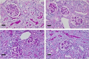 Identify a novel therapeutic target for diabetic nephropathy