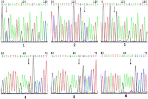 A functional polymorphism in the regulatory region of let-7a-2 is associated with an increased risk for diabetic nephropathy