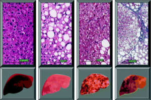 Using a systems biology approach to understand the pathogenesis of obesity-related chronic liver diseases