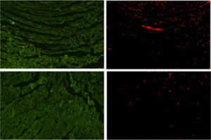 miRNA expression signature may be considered biomarker for ischemic heart disease such as AMI