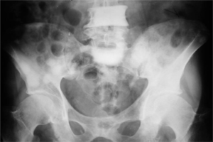 Identify miRNAs of potential therapeutic value for osteolytic diseases