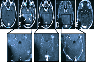 miRNAs in cerebrospinal fluid (CSF) can serve as biomarkers of treatment response in brain cancers