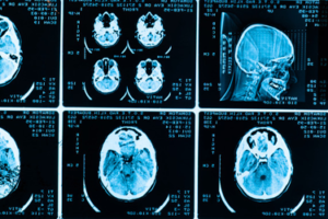 Plasma-derived miRNA biomarkers have the potential to improve TBI patient classification and possibly management